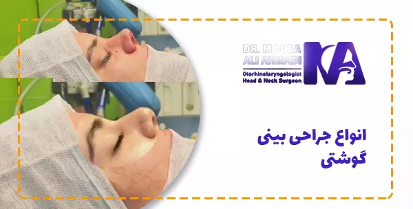انواع جراحی بینی گوشتی
