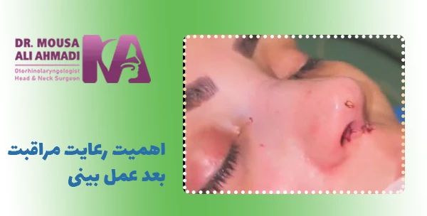 اهمیت رعایت مراقبت بعد عمل بینی