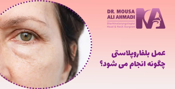 عمل بلفاروپلاستی چگونه انجام می شود؟