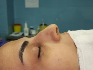 عمل بینی قوزدار