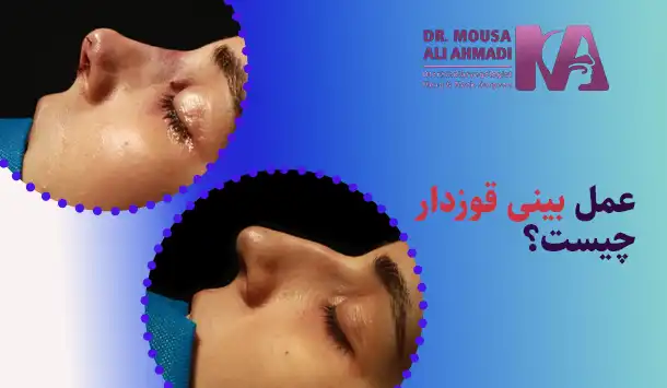 عمل بینی قوزدار چیست؟