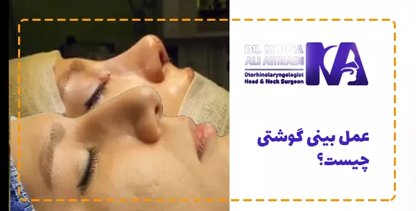 عمل بینی گوشتی چیست؟

