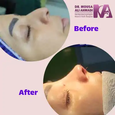 عکس قبل و بعد عمل بینی