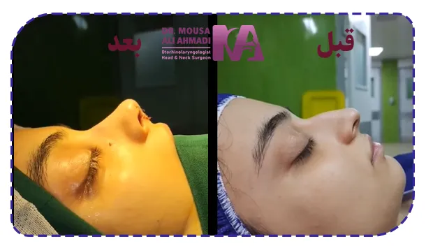 قبل و بعد از جراحی بین قوزدار