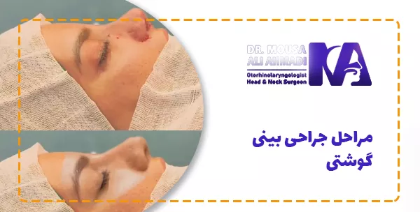 مراحل جراحی بینی گوشتی