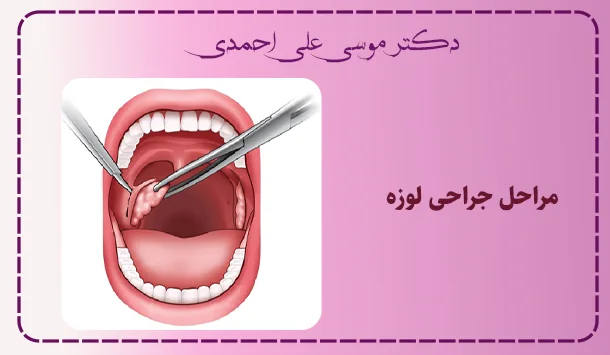 مراحل جراحی لوزه