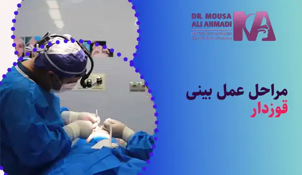 مراحل عمل بینی قوزدار