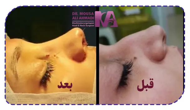 نمونه کار جراحی بینی قوزدار