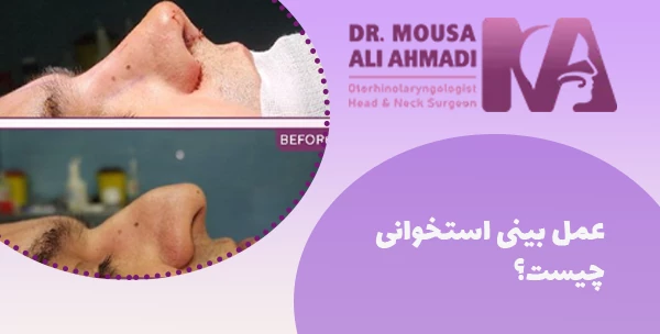 عمل بینی استخوانی چیست؟