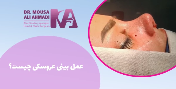 عمل بینی عروسکی چیست؟