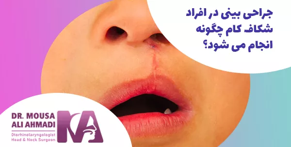 جراحی بینی در افراد شکاف کام چگونه انجام می شود؟