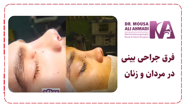 فرق جراحی بینی در مردان و زنان