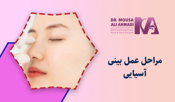 مراحل عمل بینی آسیایی 