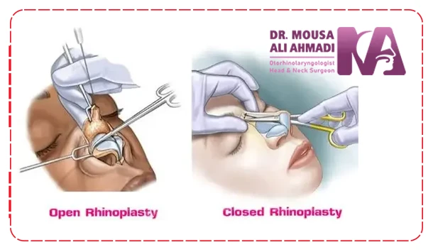 تفاوت عمل بینی بسته با عمل بینی باز