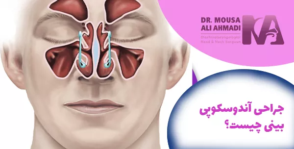 جراحی آندوسکوپی بینی چیست؟
