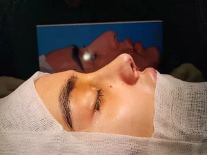 عمل بینی باز