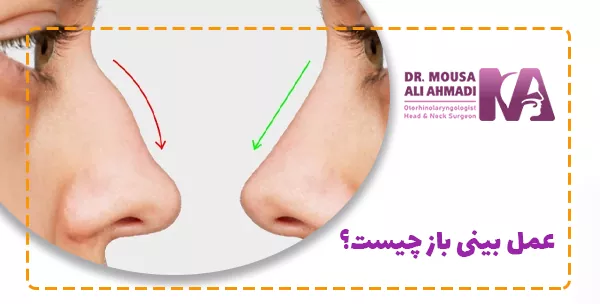 عمل بینی باز چیست؟
