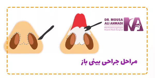 مراحل جراحی بینی باز