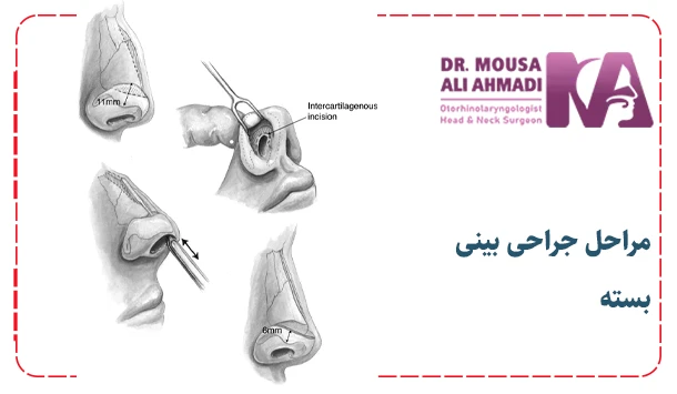 مراحل جراحی بینی بسته