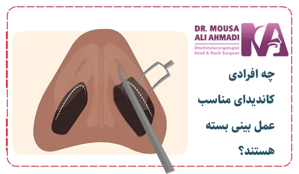 چه افرادی کاندیدای مناسب عمل بینی بسته هستند؟