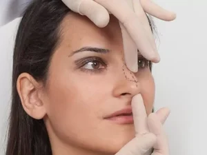 افتادگی نوک بینی بعد عمل