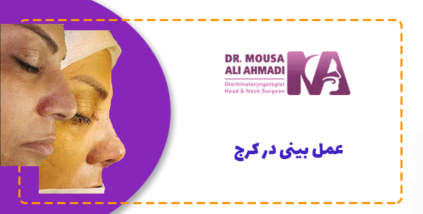 عمل بینی در کرج