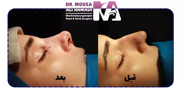 نمونه کار جراحی بینی استخوانی