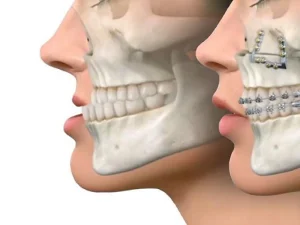 جراحی همزمان بینی و فک