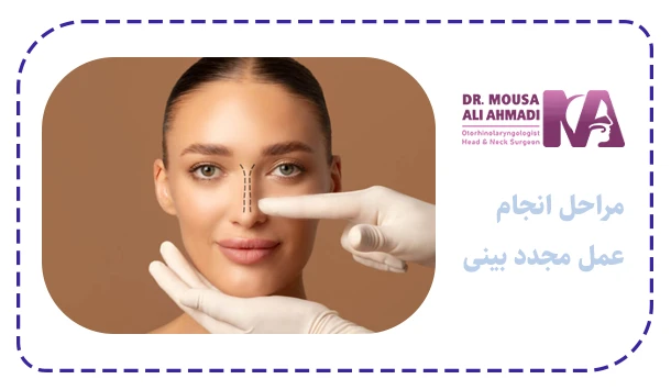 مراحل انجام عمل مجدد بینی