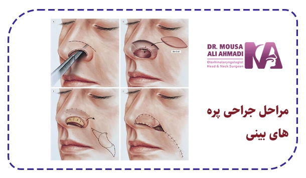 مراحل جراحی پره های بینی