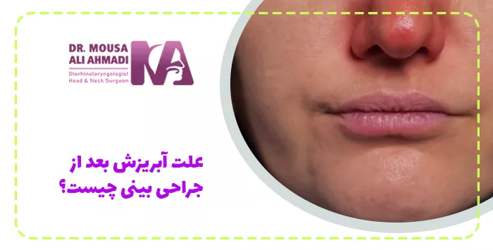 علت آبریزش بعد از جراحی بینی چیست؟