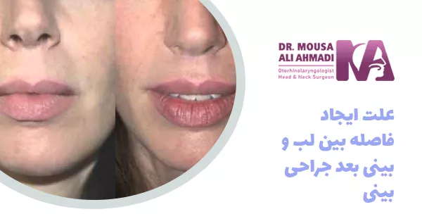 علت ایجاد فاصله بین لب و بینی بعد جراحی بینی