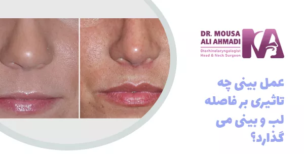 عمل بینی چه تاثیری بر فاصله لب و بینی می گذارد؟