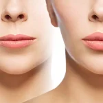 فاصله لب و بینی بعد از عمل بینی