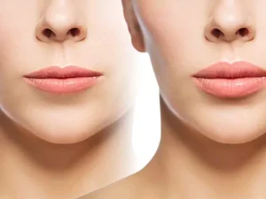 فاصله لب و بینی بعد از عمل بینی