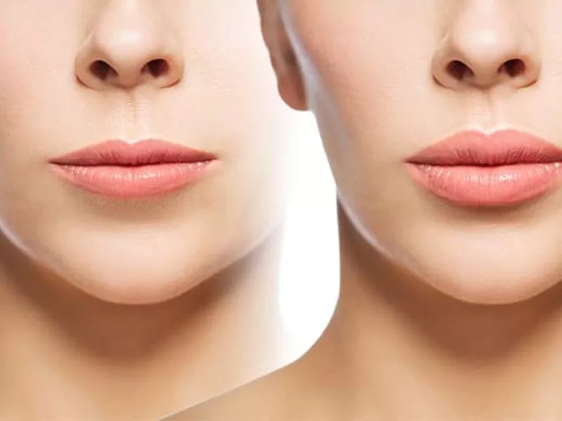 فاصله لب و بینی بعد از عمل بینی