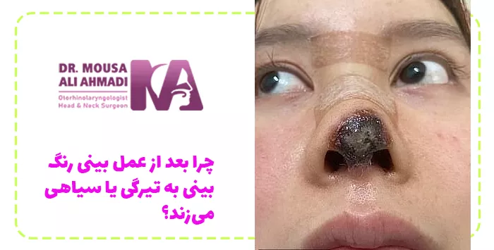چرا بعد از عمل بینی رنگ بینی به تیرگی یا سیاهی می‌زند؟