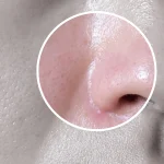 چرب شدن پوست بینی بعد جراحی