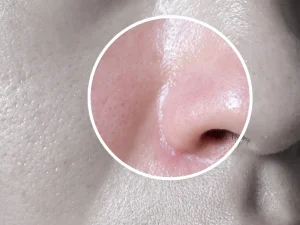 چرب شدن پوست بینی بعد جراحی