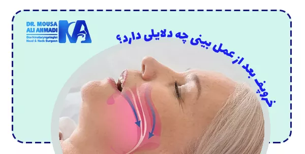 خروپف بعد از عمل بینی چه دلایلی دارد؟