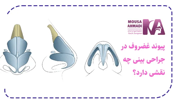 پیوند غضروف در جراحی بینی چه نقشی دارد؟
