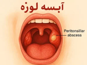 آبسه لوزه