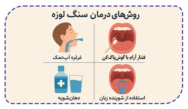 روش های درمان سنگ لوزه روش های درمان سنگ لوزه