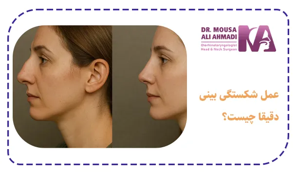 عمل شکستگی بینی دقیقا چیست؟
