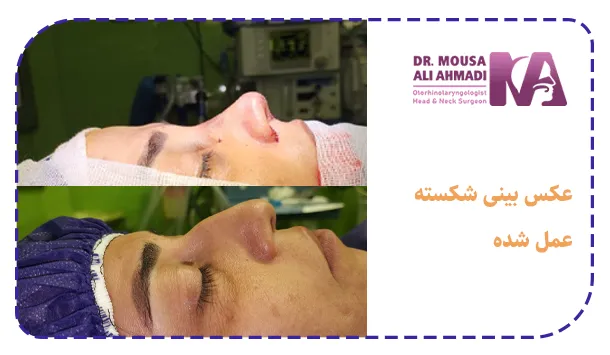 عکس بینی شکسته عمل شده