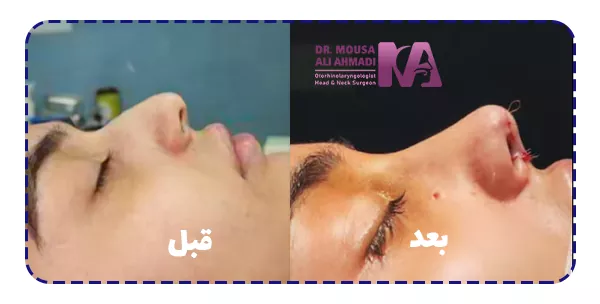 قبل وبعد از جراحی بینی قبل وبعد از جراحی بینی