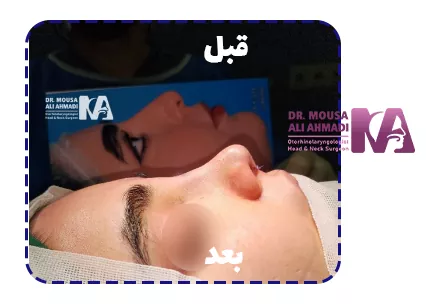 قبل وبعد از رینوپلاستی قبل وبعد از رینوپلاستی