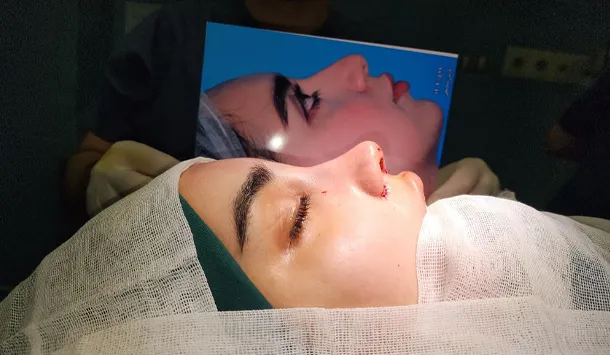 نمونه جراحی بینی توسط دکتر موسی علی احمدی