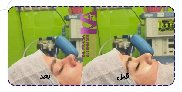 عکس نمونه کار جراحی بینی گوشتی