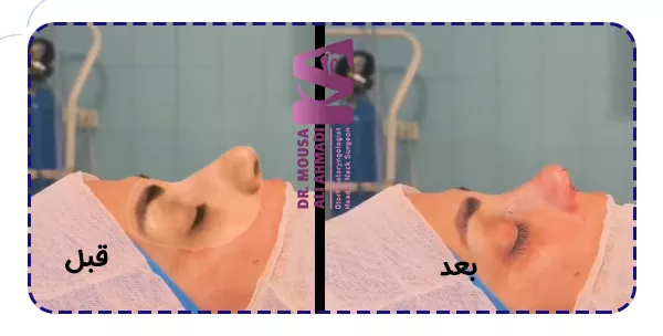 قبل و بعد جراحی بینی گوشتی
